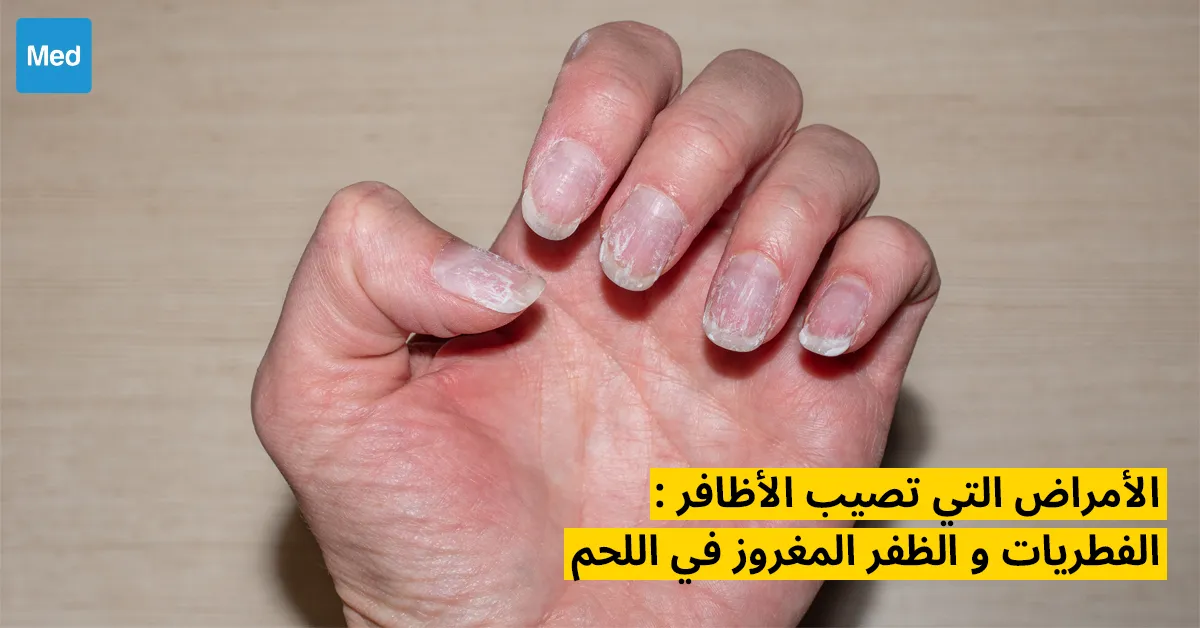 الأمراض التي تصيب الأظافر : الفطريات و الظفر المغروز في اللحم